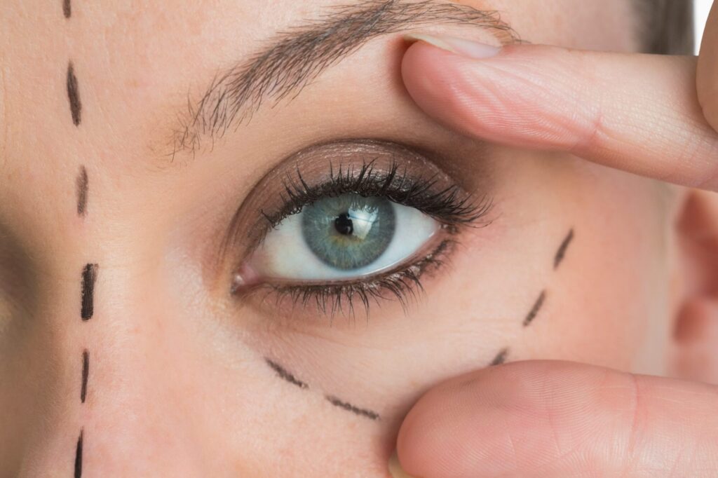 blefaroplastika